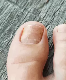 Close up shot of toenail fungus on man's foot