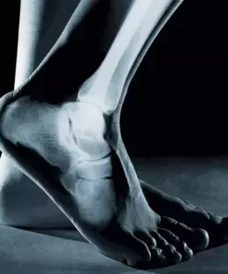 X-ray close up of raised heel