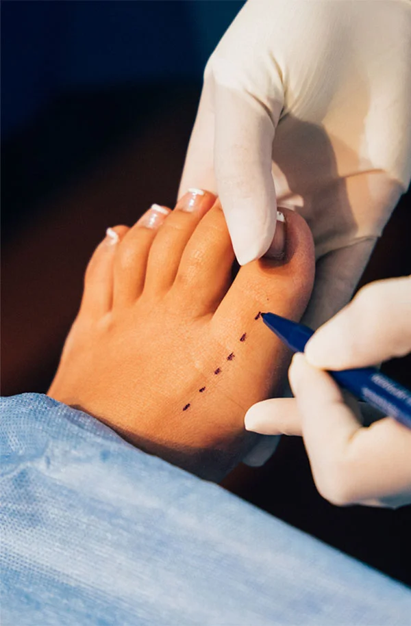 AIRE Podiatry Studio featured procedure Bunions